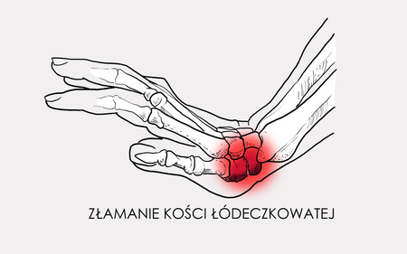 Orteza na dłoń i przedramię korygująca zniekształcenie ręki M prawa